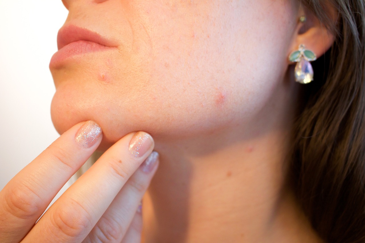 Sekrety Dermatologów: Jak Skutecznie Walczyć z Trądzikiem